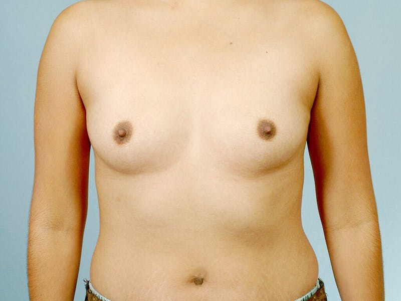 Breast Augmentation Before & After Gallery - Patient 20912939 - Image 1