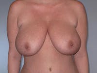 Breast Reduction Before & After Gallery - Patient 20912940 - Image 1