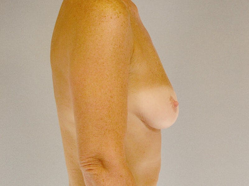 Breast Augmentation Before & After Gallery - Patient 20912949 - Image 5