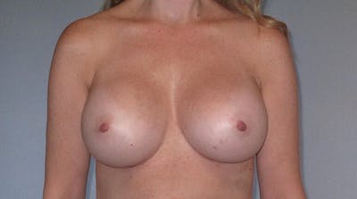 Breast Augmentation Before & After Gallery - Patient 20912952 - Image 2