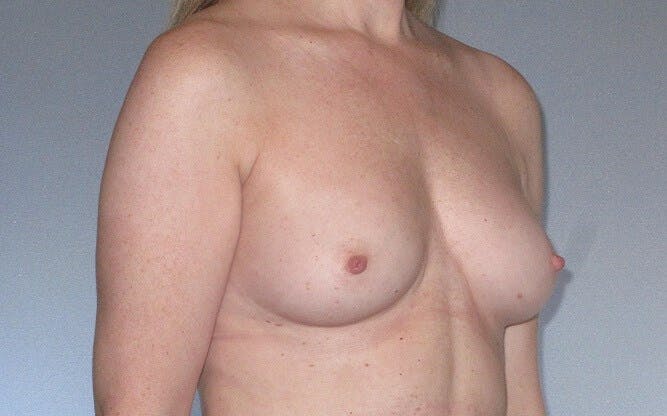 Breast Augmentation Before & After Gallery - Patient 20912952 - Image 3