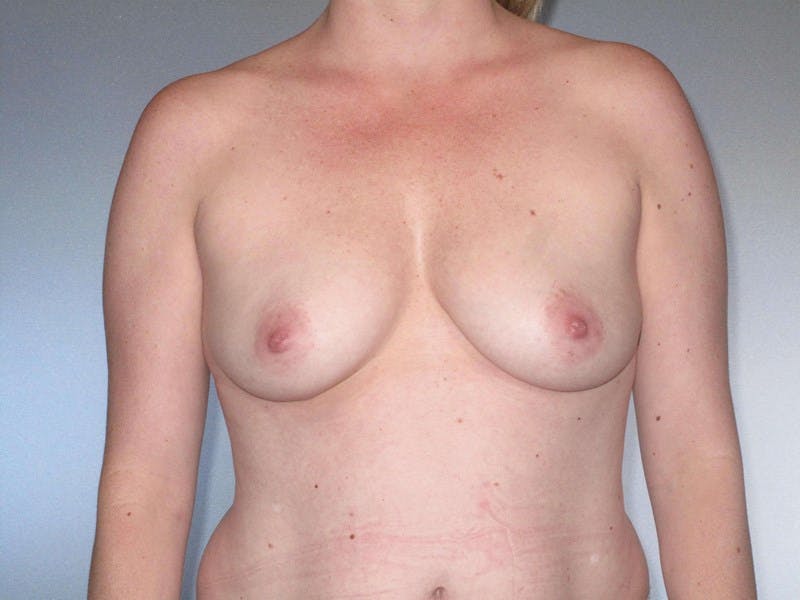 Breast Augmentation Before & After Gallery - Patient 20912954 - Image 3