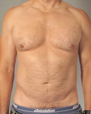 Abdominal Etching Before & After Gallery - Patient 20912959 - Image 1