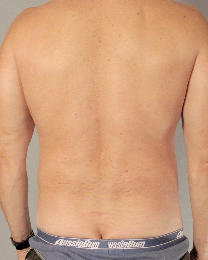 Abdominal Etching Before & After Gallery - Patient 20912959 - Image 7