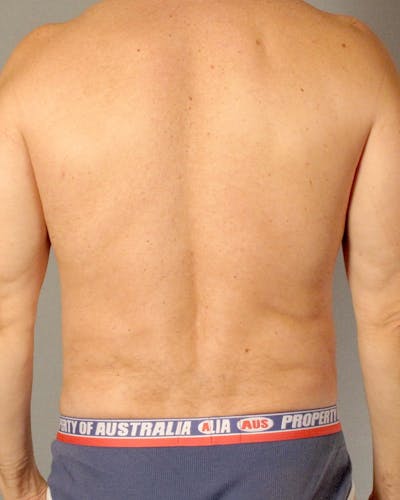 Abdominal Etching Before & After Gallery - Patient 20912959 - Image 8