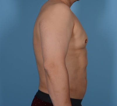 Abdominal Etching Before & After Gallery - Patient 20912961 - Image 6