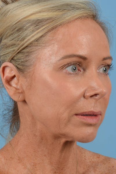 Laser Skin Resurfacing Before & After Gallery - Patient 20913099 - Image 1