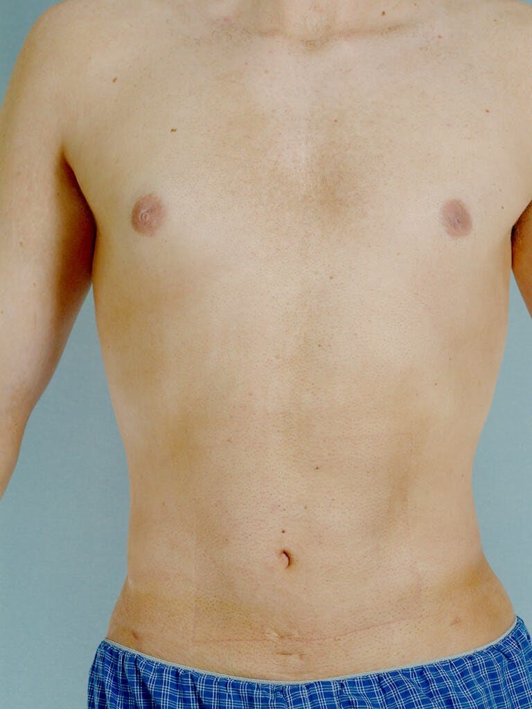 Abdominal Etching Before & After Gallery - Patient 20913097 - Image 2