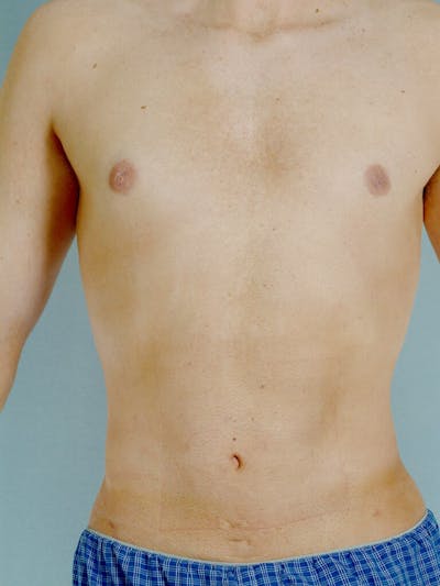 Abdominal Etching Before & After Gallery - Patient 20913097 - Image 2