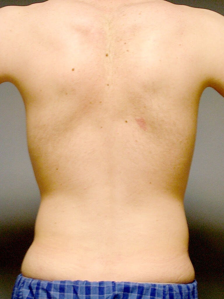 Abdominal Etching Before & After Gallery - Patient 20913097 - Image 7