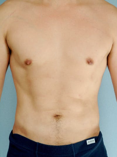 Abdominal Etching Before & After Gallery - Patient 20913100 - Image 2