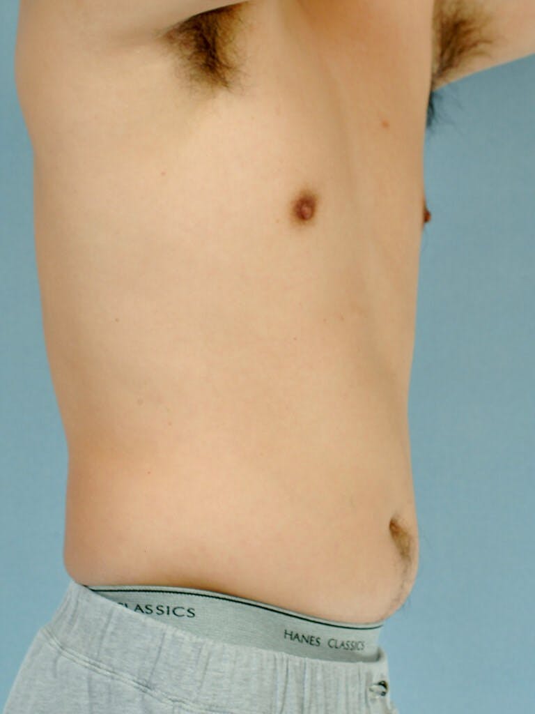 Abdominal Etching Before & After Gallery - Patient 20913100 - Image 3