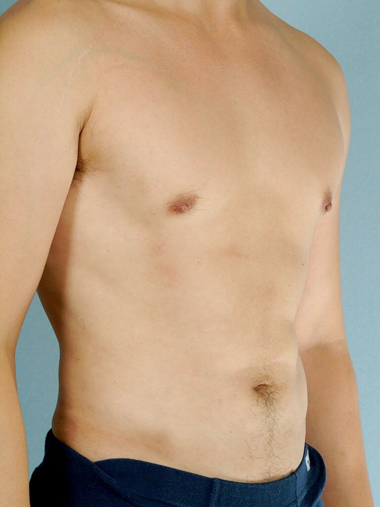 Abdominal Etching Before & After Gallery - Patient 20913100 - Image 4