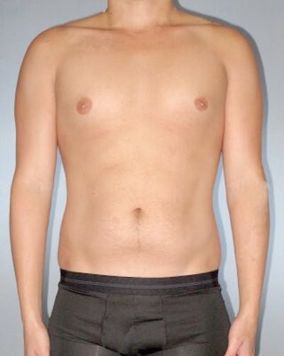 Abdominal Etching Before & After Gallery - Patient 20913101 - Image 1