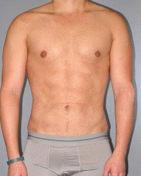 Abdominal Etching Before & After Gallery - Patient 20913101 - Image 2