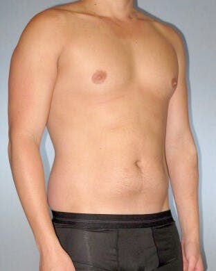 Abdominal Etching Before & After Gallery - Patient 20913101 - Image 3