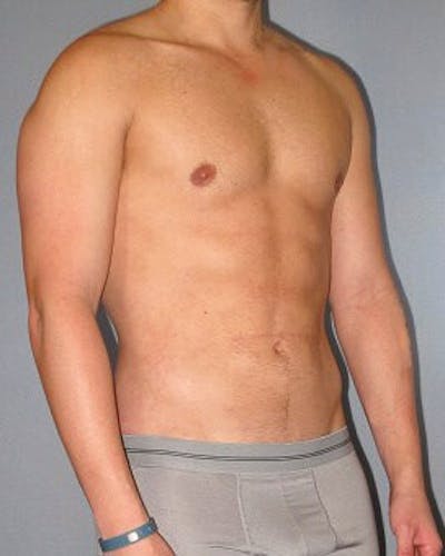 Abdominal Etching Before & After Gallery - Patient 20913101 - Image 4
