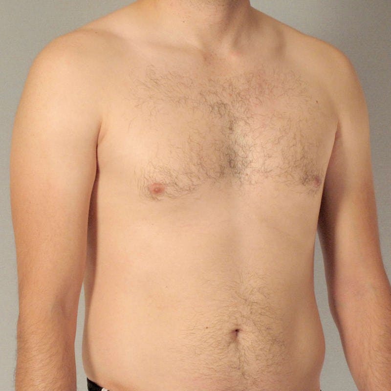 Abdominal Etching Before & After Gallery - Patient 20913104 - Image 3