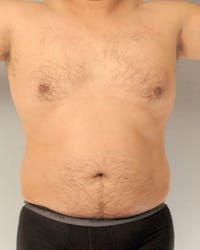 Abdominal Etching Before & After Gallery - Patient 20913105 - Image 1
