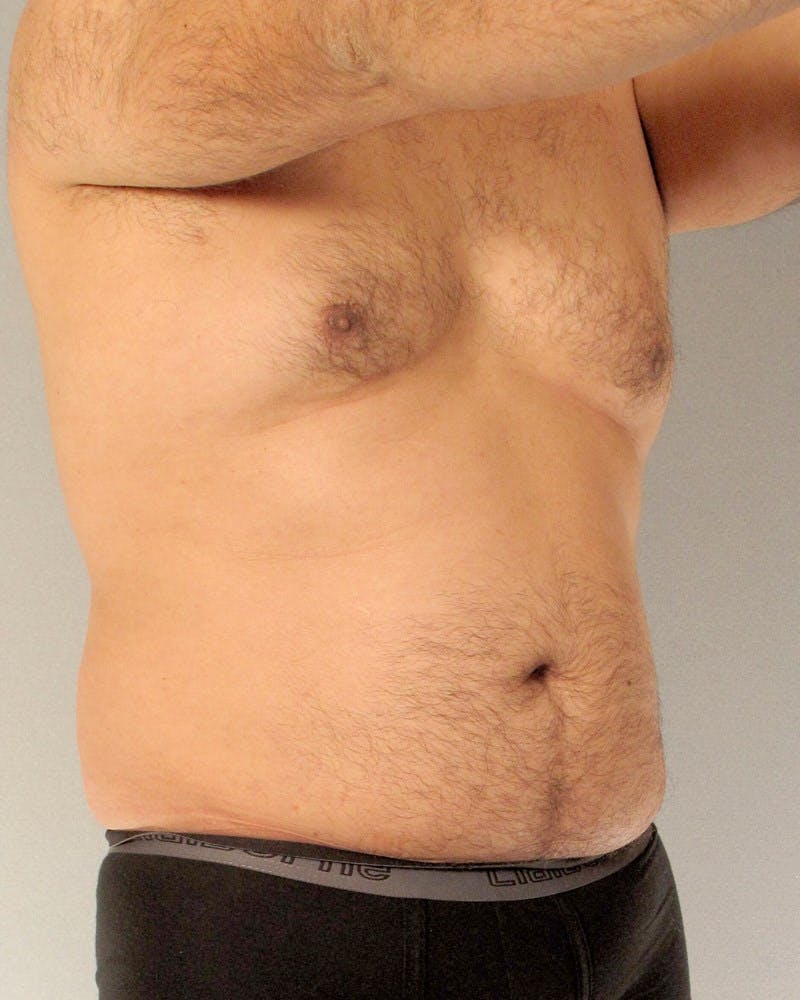 Abdominal Etching Before & After Gallery - Patient 20913105 - Image 3