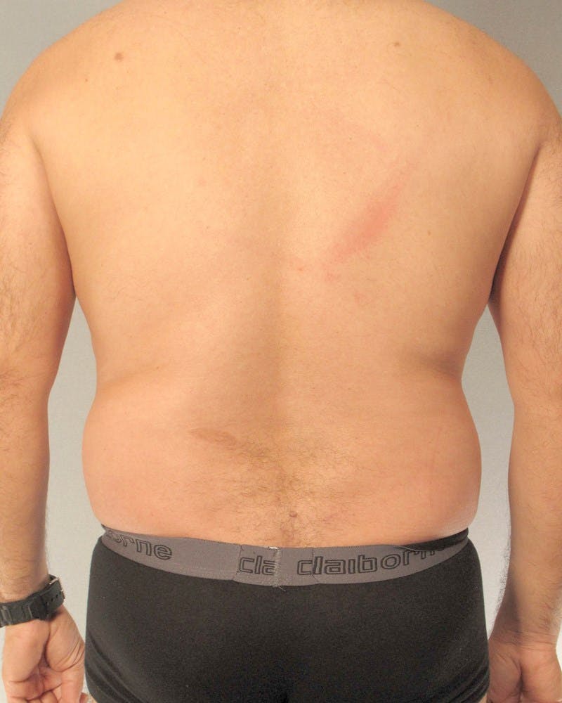 Abdominal Etching Before & After Gallery - Patient 20913105 - Image 7