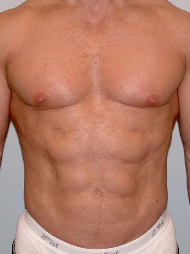 Abdominal Etching Before & After Gallery - Patient 20913106 - Image 2