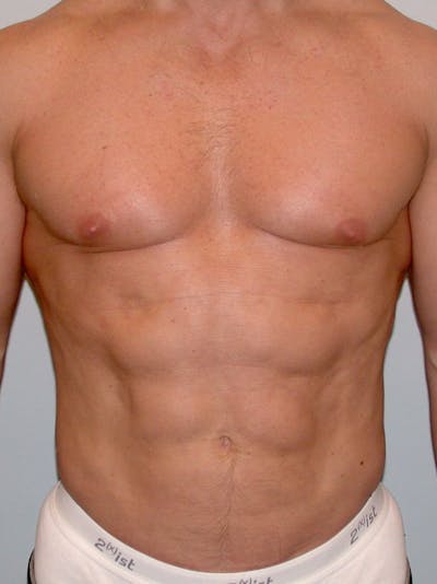 Abdominal Etching Before & After Gallery - Patient 20913106 - Image 2