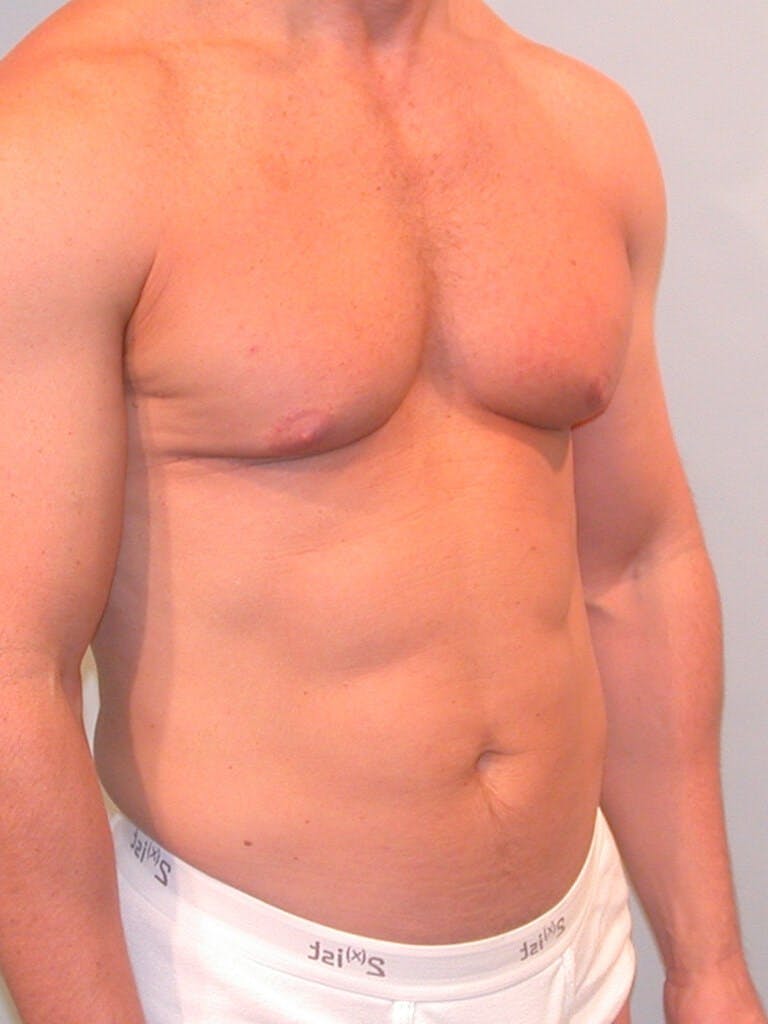 Abdominal Etching Before & After Gallery - Patient 20913106 - Image 3