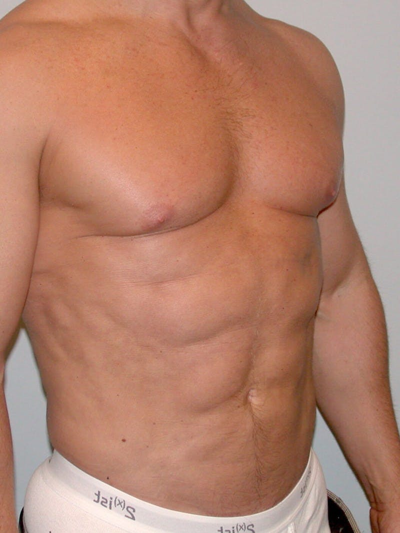 Abdominal Etching Before & After Gallery - Patient 20913106 - Image 4