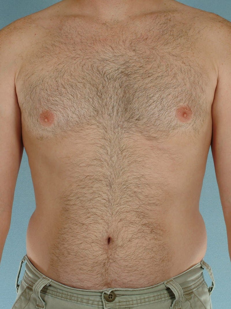 Abdominal Etching Before & After Gallery - Patient 20913108 - Image 1