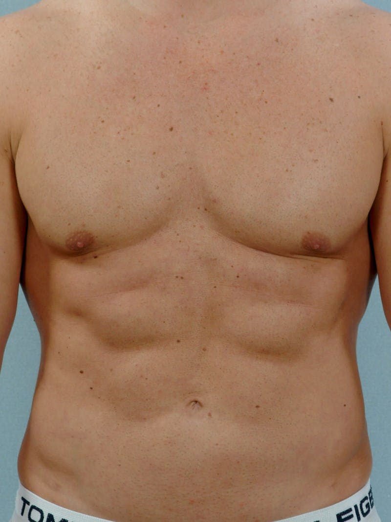 Abdominal Etching Before & After Gallery - Patient 20913118 - Image 2