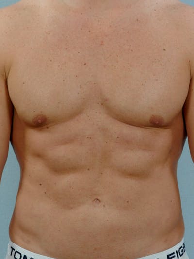 Abdominal Etching Before & After Gallery - Patient 20913118 - Image 2