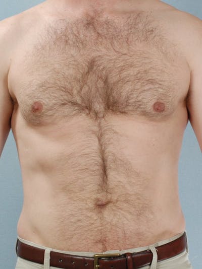 Abdominal Etching Before & After Gallery - Patient 20913120 - Image 2