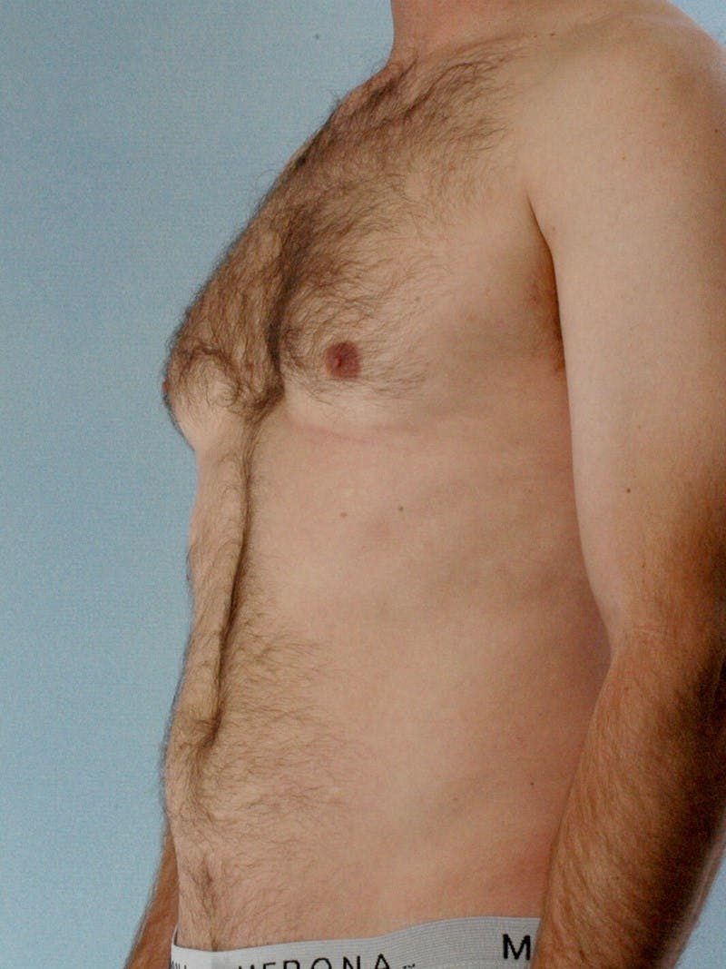 Abdominal Etching Before & After Gallery - Patient 20913120 - Image 3