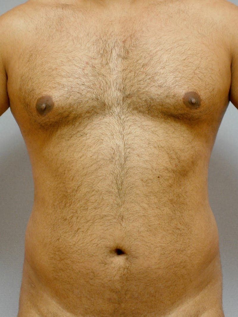 Abdominal Etching Before & After Gallery - Patient 20913121 - Image 1