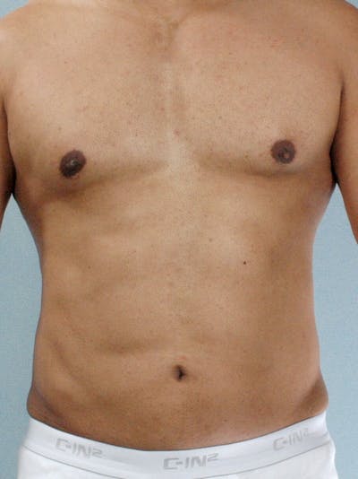 Abdominal Etching Gallery - Patient 20913121 - Image 2