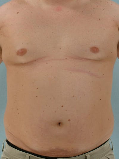 Abdominal Etching Before & After Gallery - Patient 20913123 - Image 1