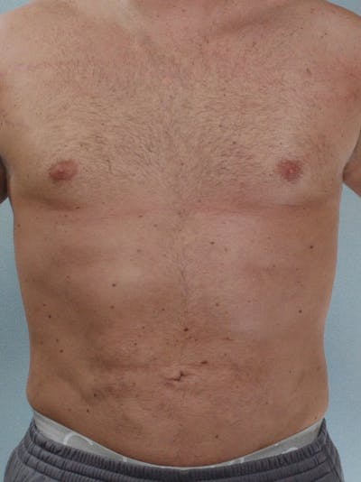Abdominal Etching Gallery - Patient 20913123 - Image 2