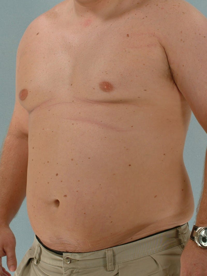 Abdominal Etching Before & After Gallery - Patient 20913123 - Image 3