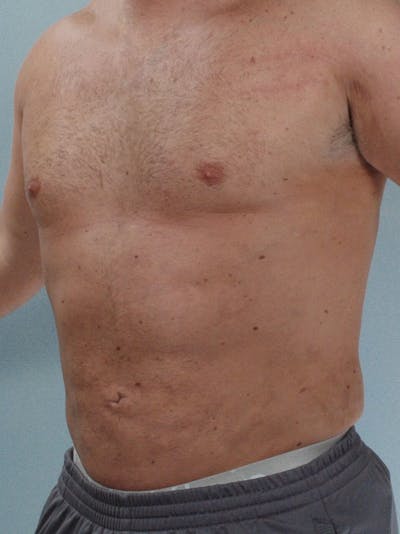 Abdominal Etching Before & After Gallery - Patient 20913123 - Image 4