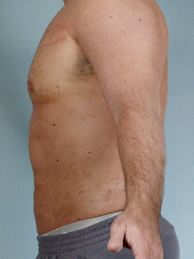 Abdominal Etching Before & After Gallery - Patient 20913123 - Image 6