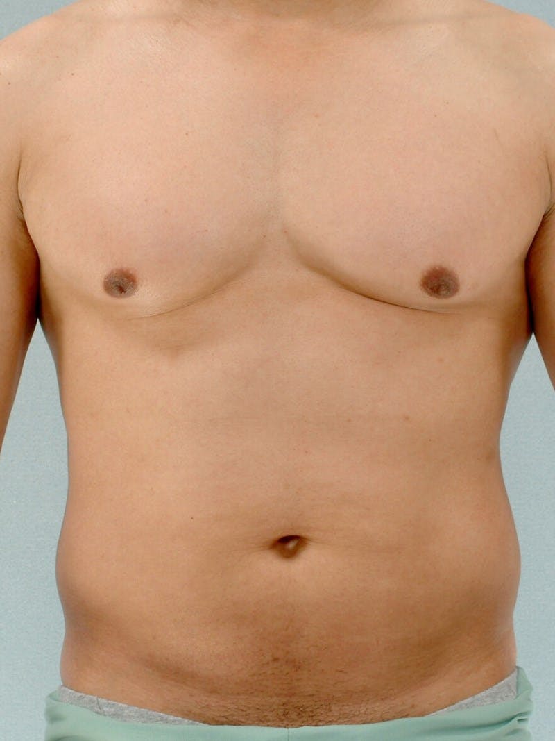 Abdominal Etching Before & After Gallery - Patient 20913125 - Image 1