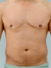Abdominal Etching Before & After Gallery - Patient 20913125 - Image 1