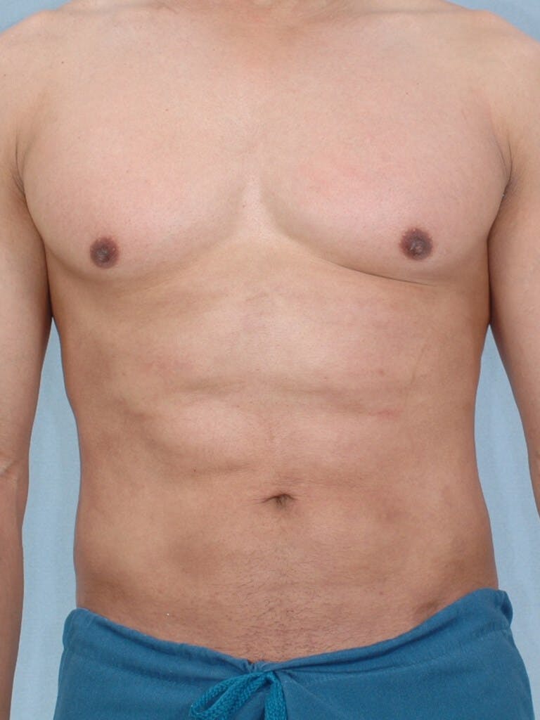 Abdominal Etching Before & After Gallery - Patient 20913125 - Image 2