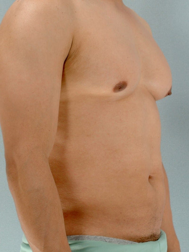 Abdominal Etching Before & After Gallery - Patient 20913125 - Image 3