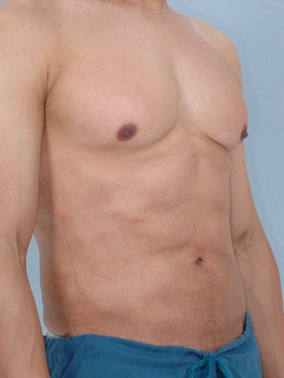 Abdominal Etching Before & After Gallery - Patient 20913125 - Image 4