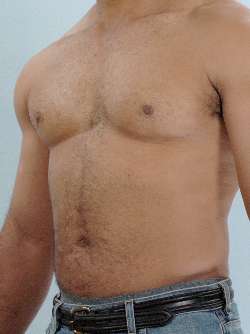 Abdominal Etching Before & After Gallery - Patient 20913132 - Image 3