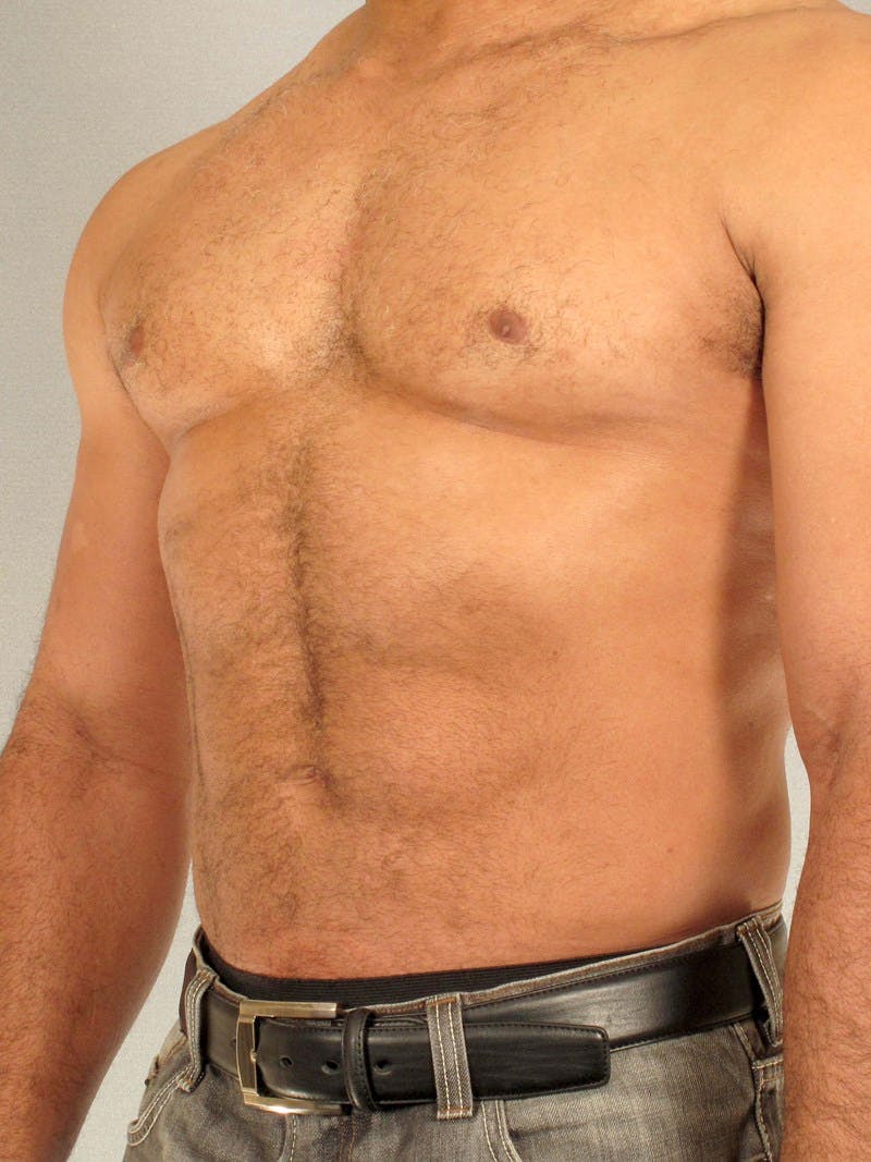 Abdominal Etching Before & After Gallery - Patient 20913132 - Image 4