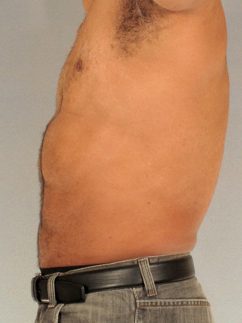 Abdominal Etching Before & After Gallery - Patient 20913132 - Image 6