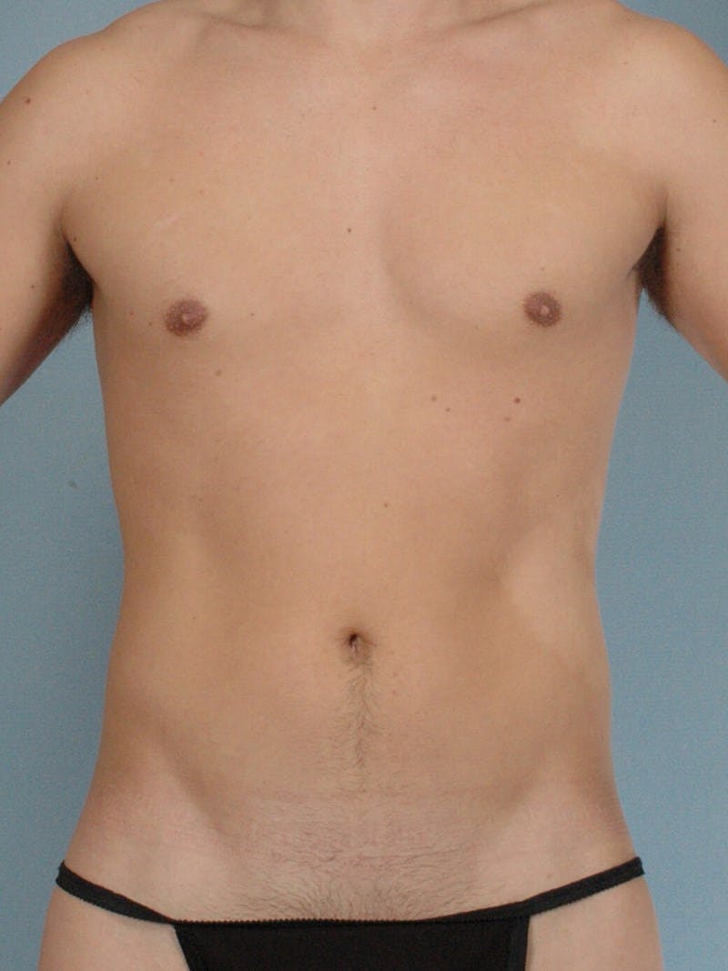 Abdominal Etching Before & After Gallery - Patient 20913141 - Image 1
